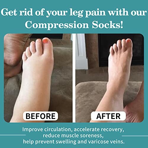 Before and after using compression socks showing improved leg condition.